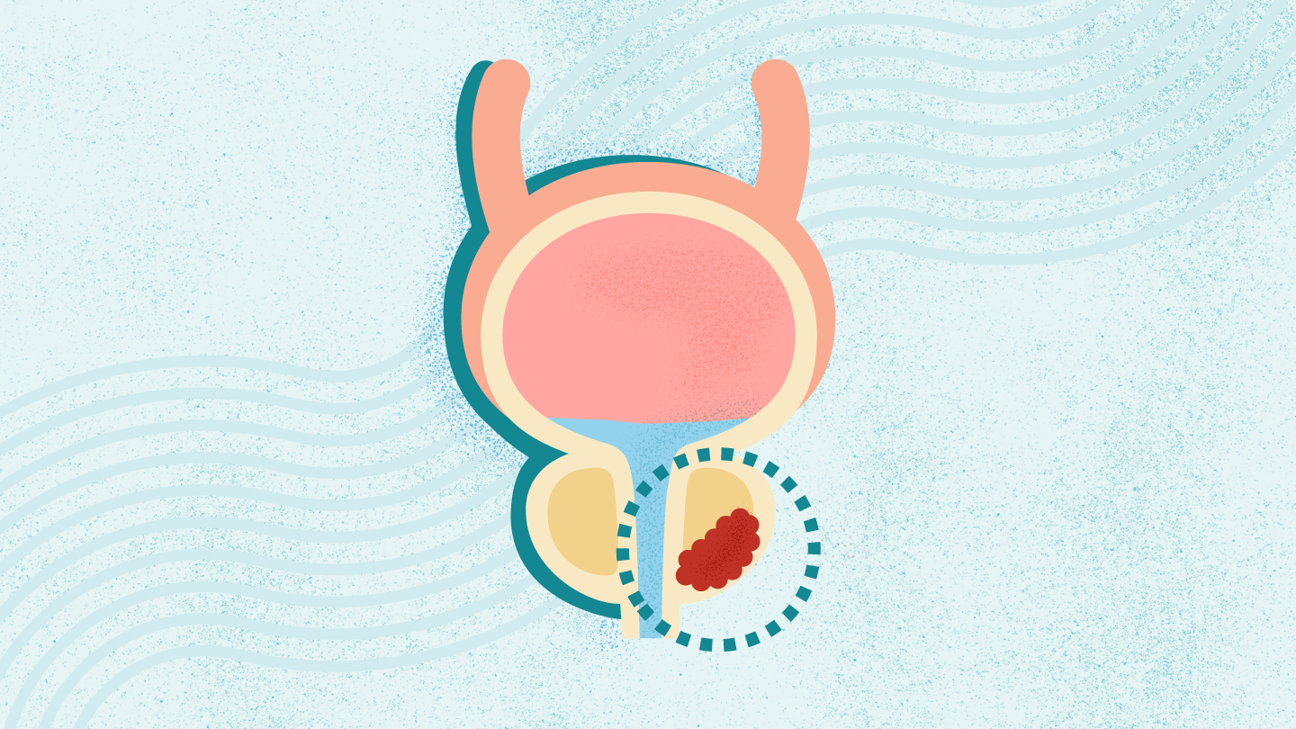 Understanding and Addressing Prostate Cancer Disparities